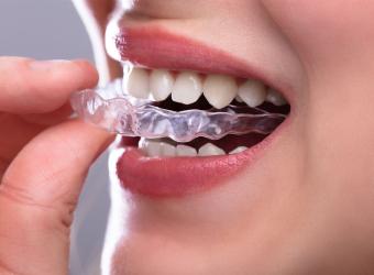 Problems with Your Bite? You Need Invisalign!