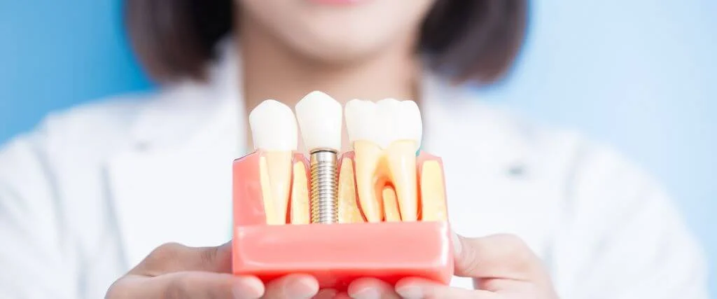 dental implants restoration strategies