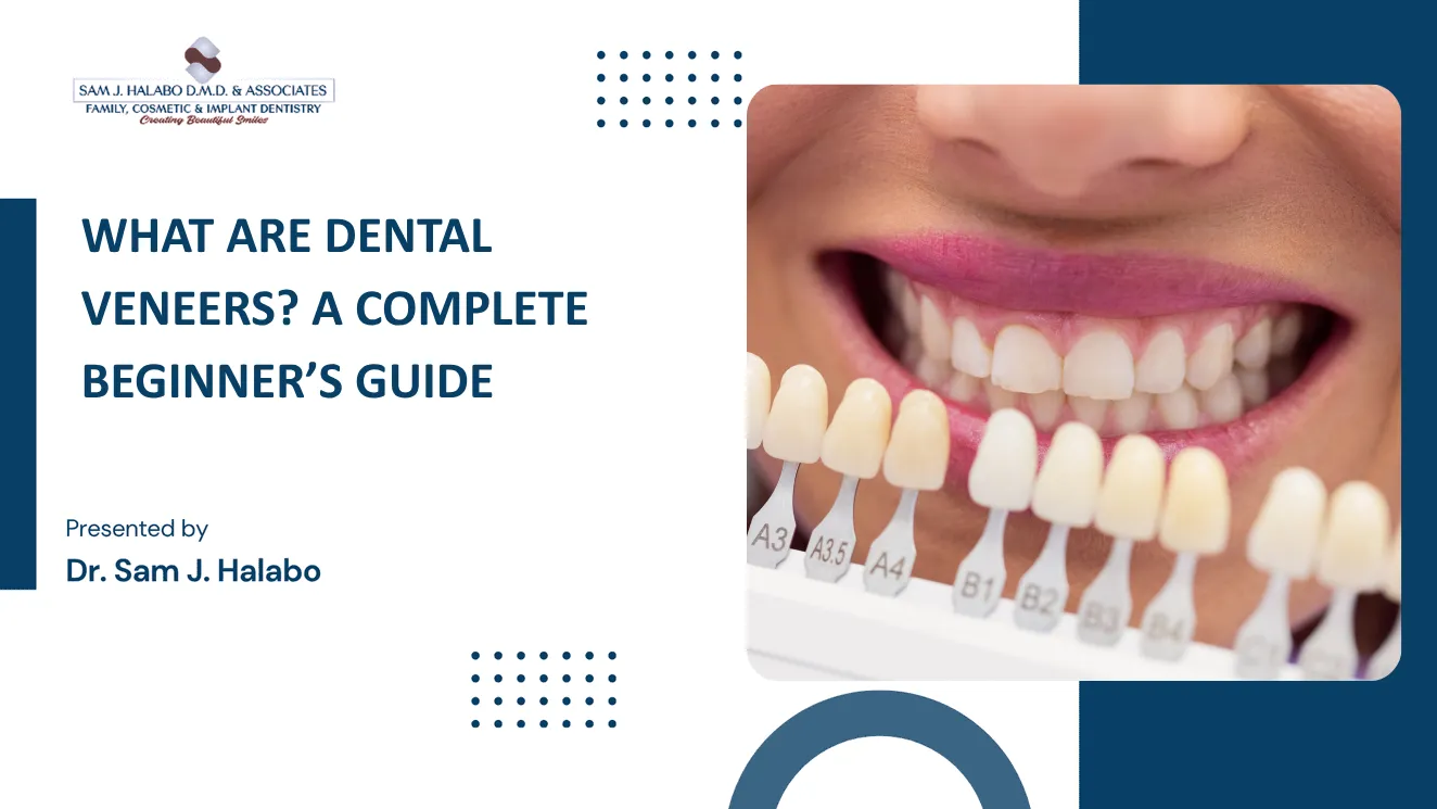 what are dental veneers guide chula vista