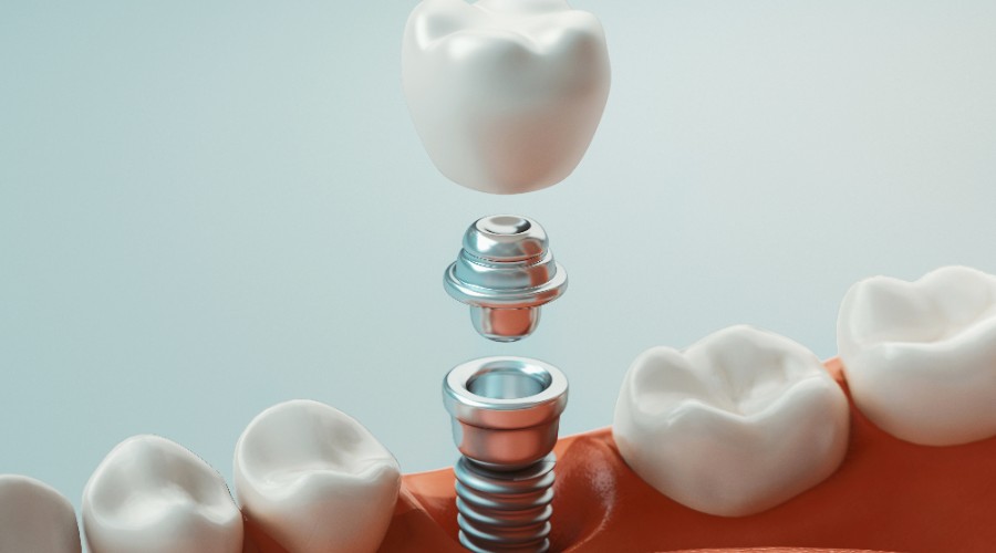 implant special